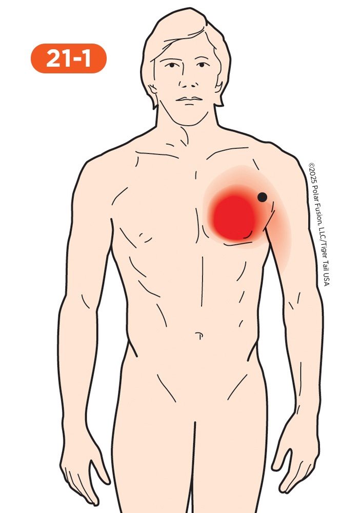 Chest Pain 21-1 Pectoralis Major Lateral Margin