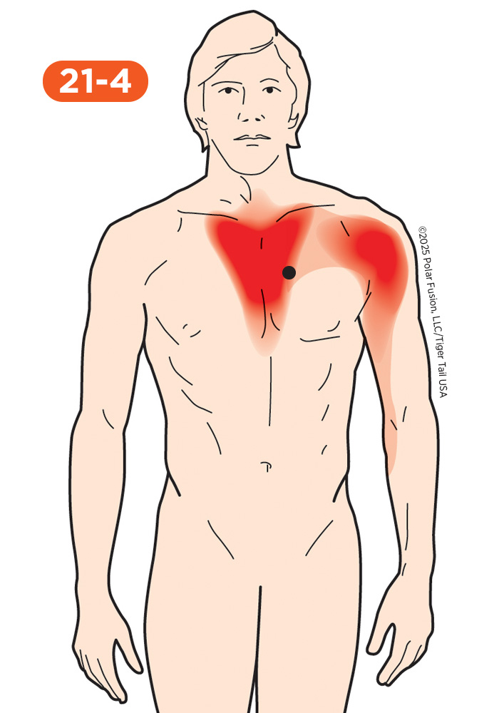 Chest Pain 21-4 Sternalis
