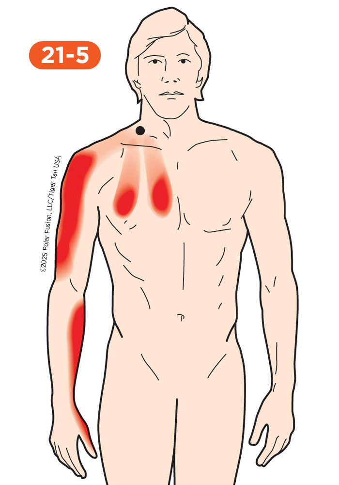Chest Pain 21-5 Scalene Muscles, Anterior Medius and Posterior