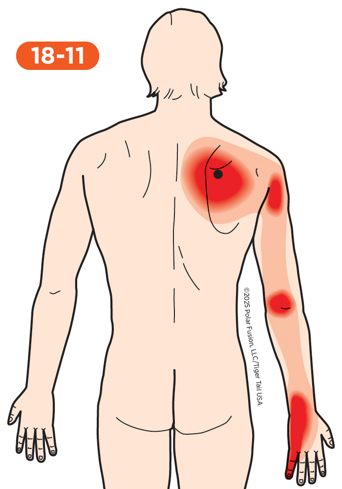 Elbow Pain 18-11 Serratus Posterior Superior