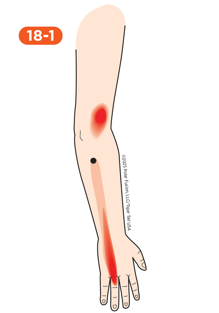 Elbow Pain 18-1 Ring Finger Extensor