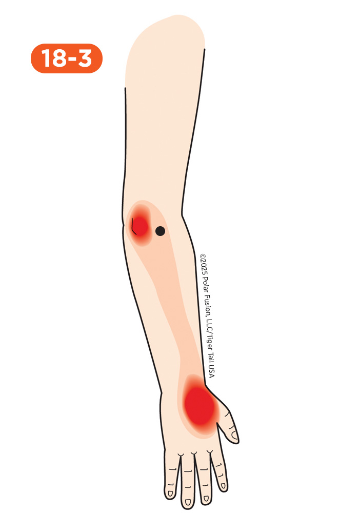 Elbow Pain 18-3 Extensor Carpi Radialis Longus