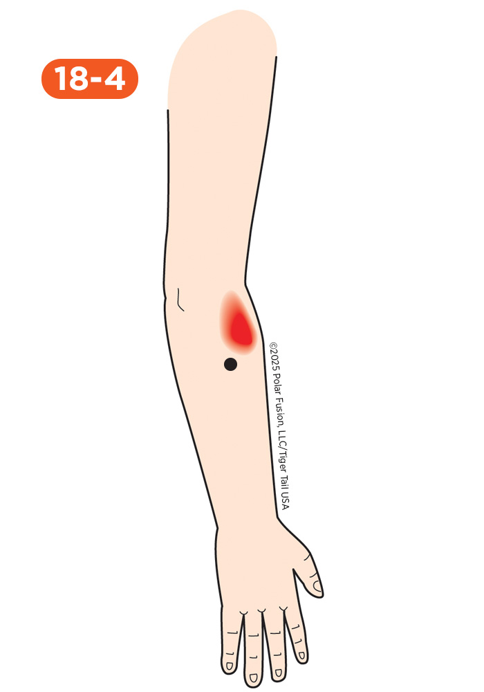 Elbow Pain 18-4 Anconeus