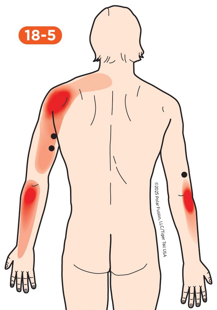 Elbow Pain 18-5 Triceps Brachii