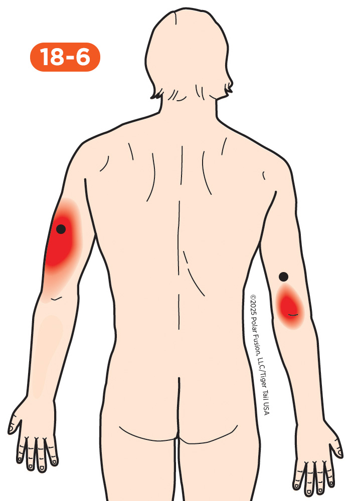 Elbow Pain 18-6 Triceps Brachii