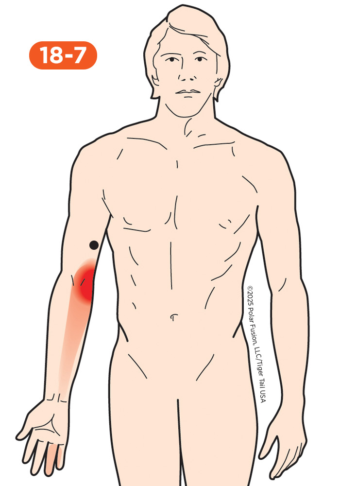 Elbow Pain 18-7 Triceps Brachii