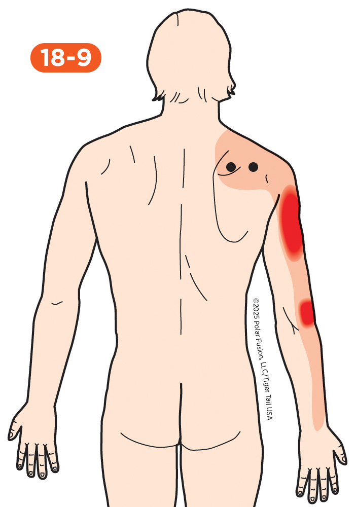 Elbow Pain 18-9 Supraspinatus