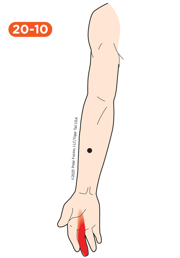 Hand Finger Thumb Pain 20-10 Flexor Digitorum Radial Head