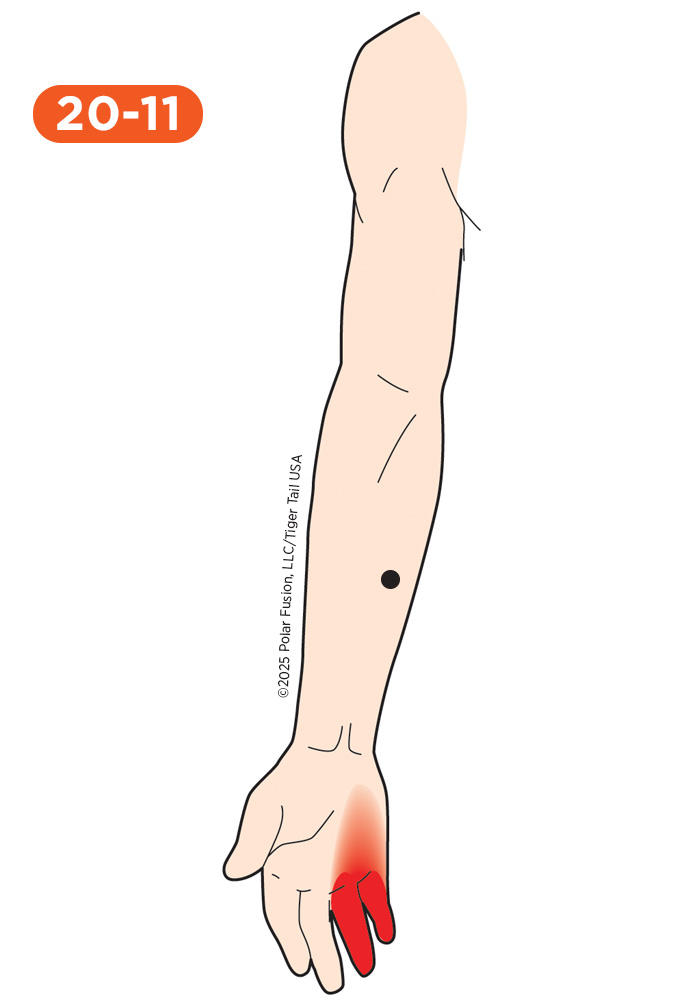 Hand Finger Thumb Pain 20-11 Flexor Digitorum Humeral Head