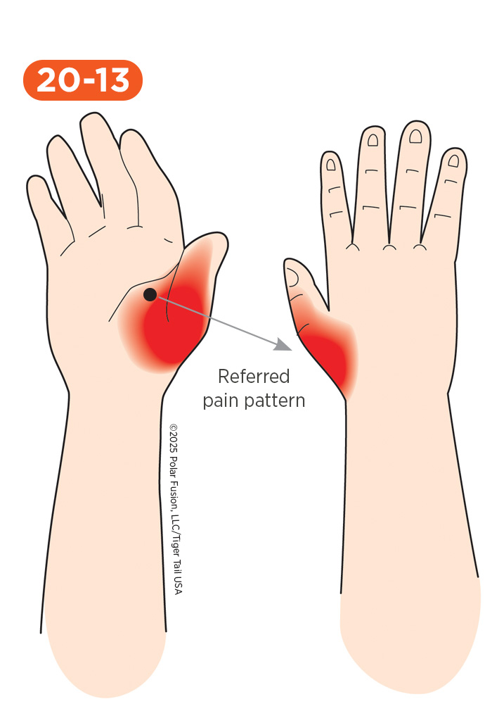 Hand Finger Thumb Pain 20-13 Adductor Pollicis