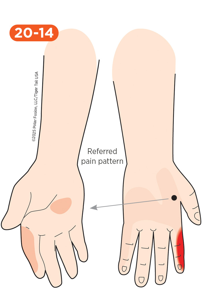 Hand Finger Thumb Pain 20-14 First Dorsal Interosseous