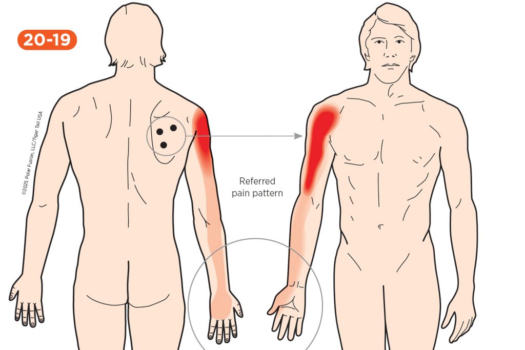 Hand Finger Thumb Pain 20-19 Infraspinatus
