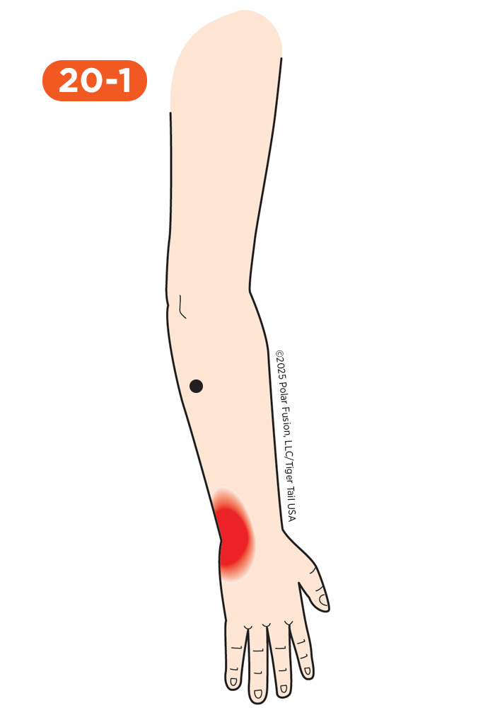 Hand Finger Thumb Pain 20-1 Extensor Carpi Ulnaris