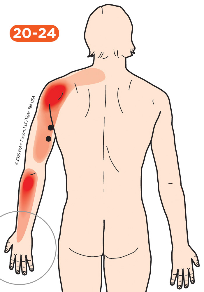 Hand Finger Thumb Pain 20-24 Triceps Brachii