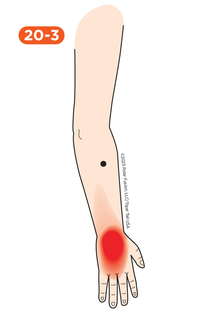 Hand Finger Thumb Pain 20-3 Extensor Carpi Radialis Brevis