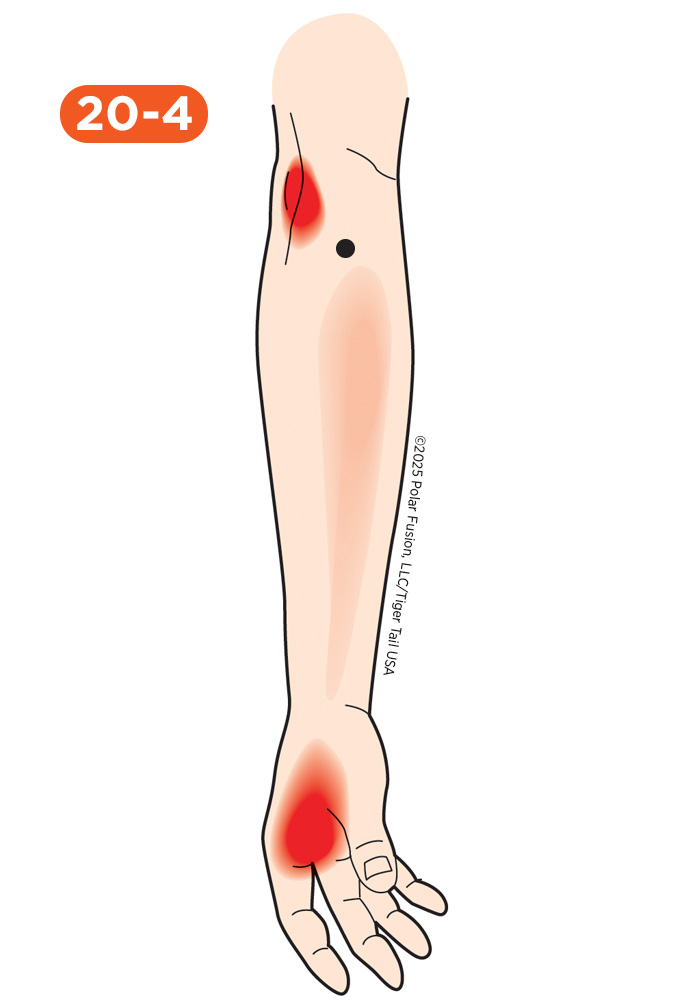 Hand Finger Thumb Pain 20-4 Brachioradialis