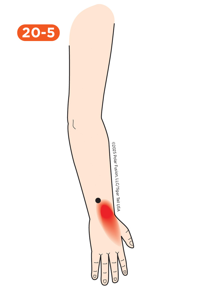 Hand Finger Thumb Pain 20-5 Extensor Indicis