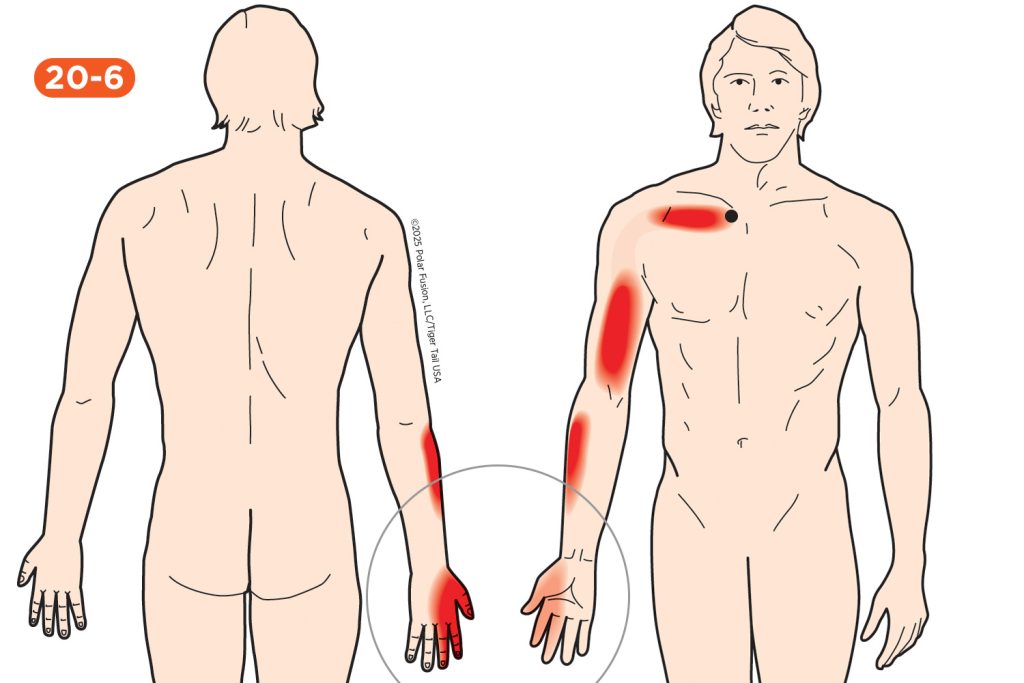 Hand Finger Thumb Pain 20-6 Subclavius