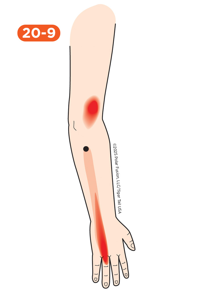 Hand Finger Thumb Pain 20-9 Ring Finger Extensor