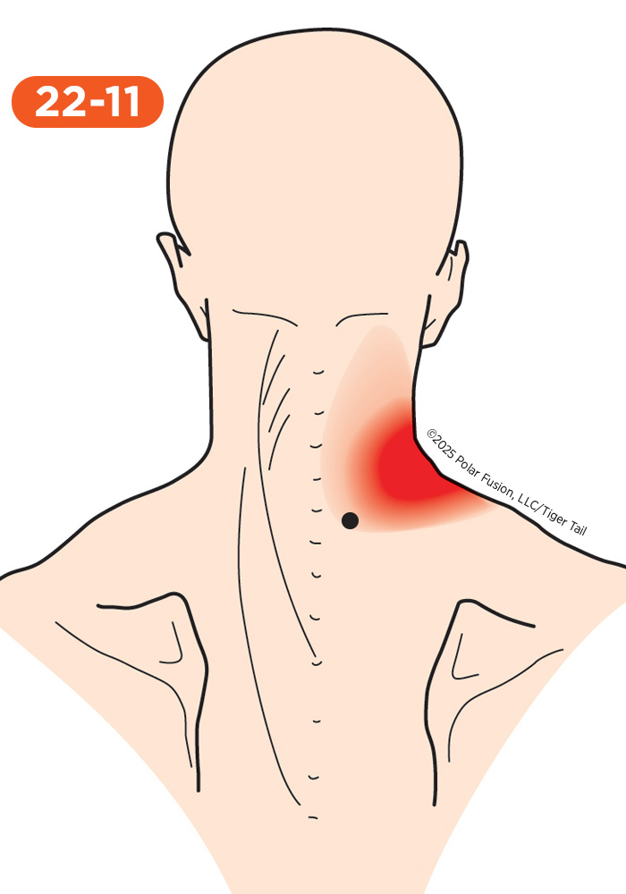 Head and Neck Pain 22-11 Lower Splenius Cervicis