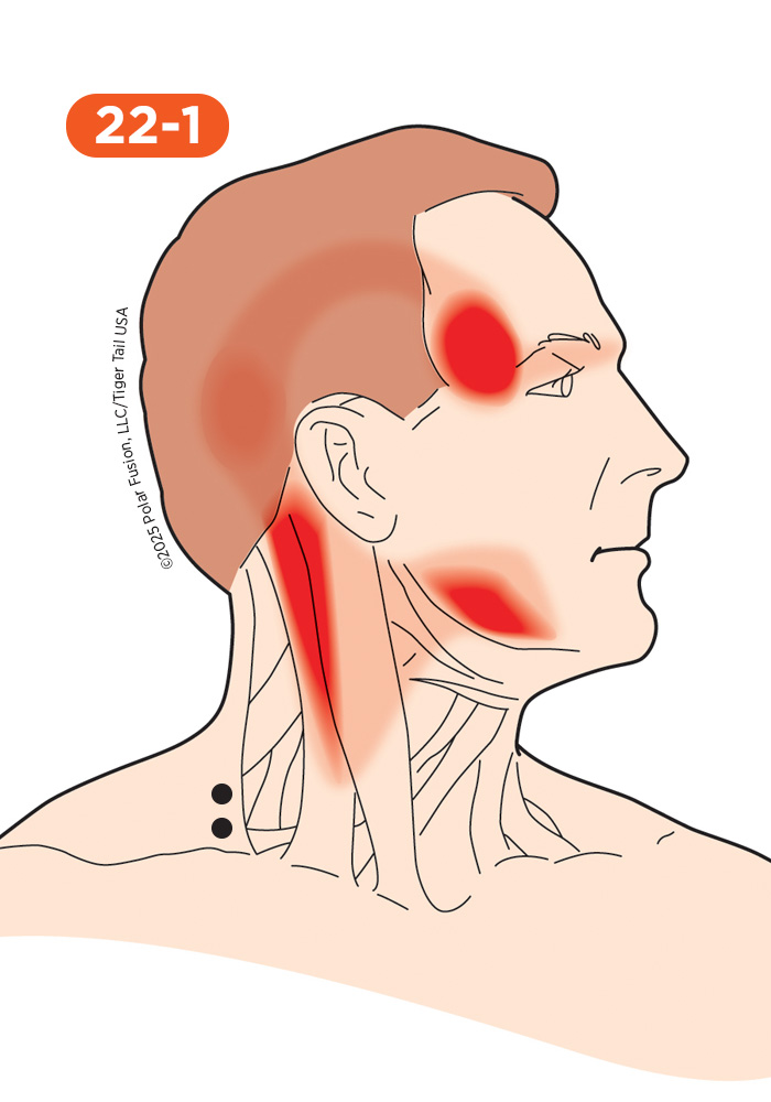 Head and Neck Pain 22-1 Trapezius