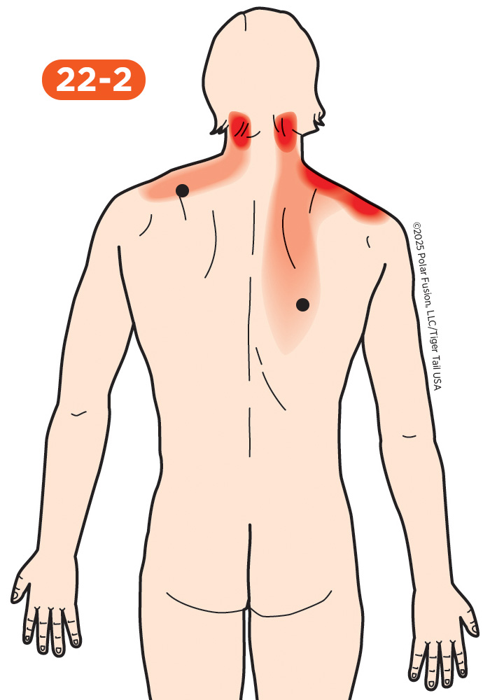 Head and Neck Pain 22-2 Trapezius