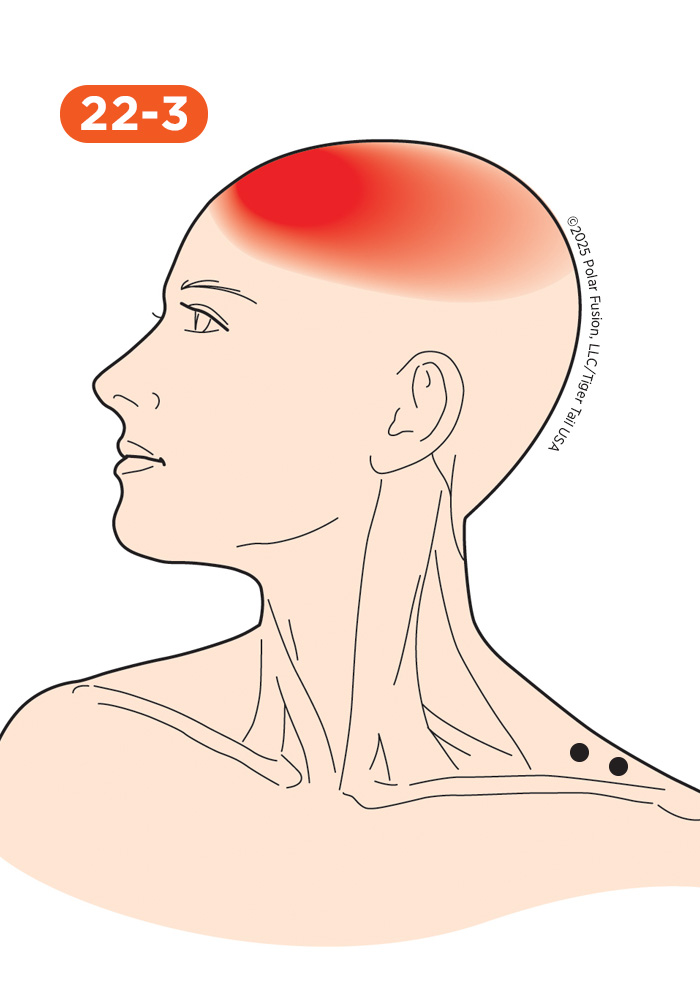 Head and Neck Pain 22-3 Trapezius