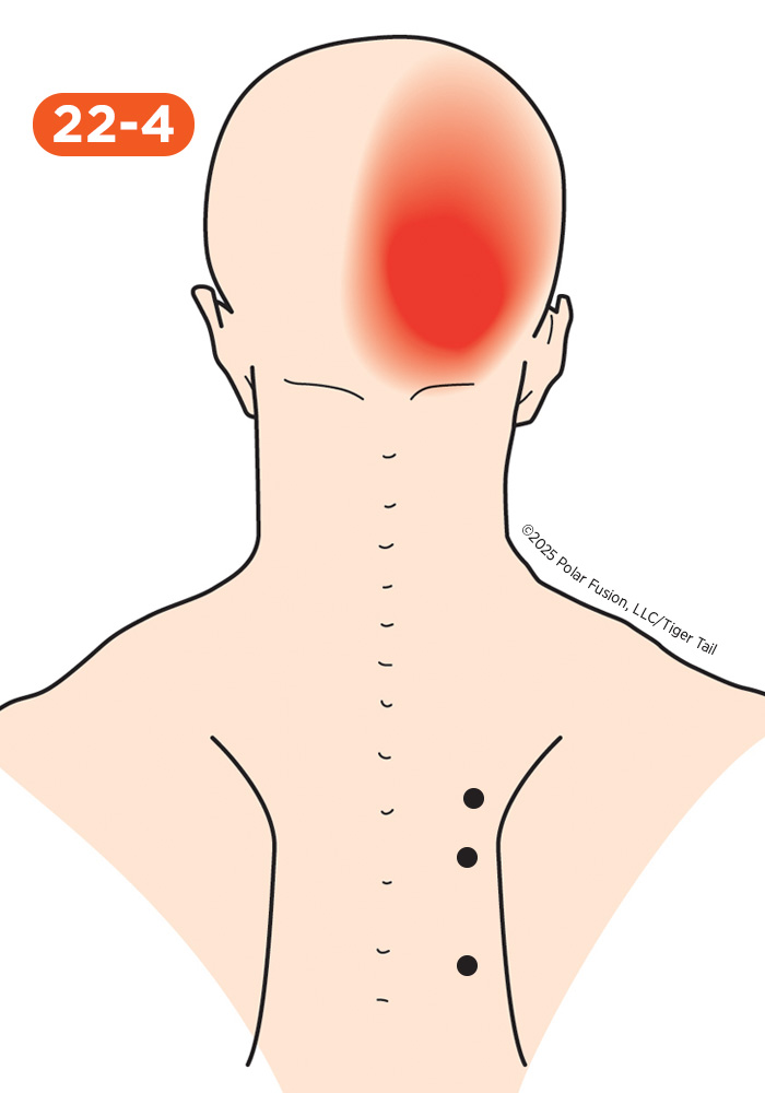Head and Neck Pain 22-4 Rhomboideus
