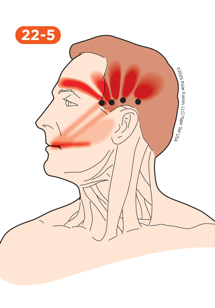 Head and Neck Pain 22-5 Temporalis