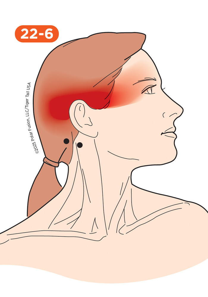 Head and Neck Pain 22-6 Suboccipital