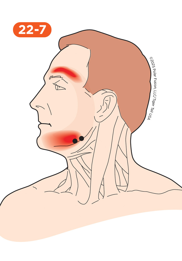 Head and Neck Pain 22-7 Masseter Superficial
