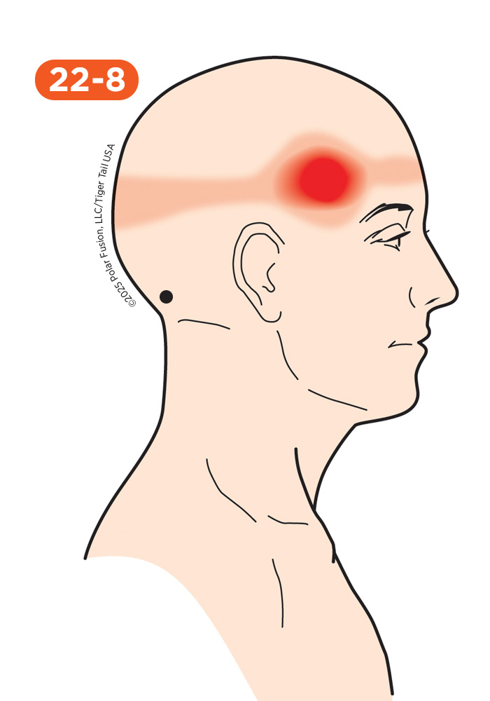 Head and Neck Pain 22-8 Semispinalis Capitis