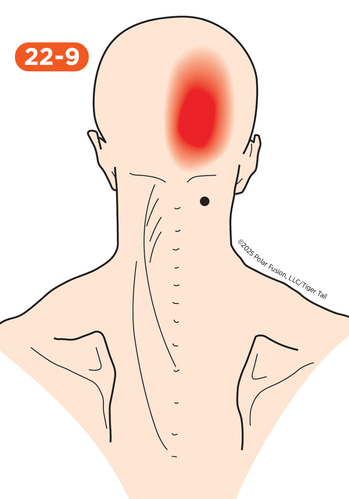 Head and Neck Pain 22-9 Semispinalis Cervicis