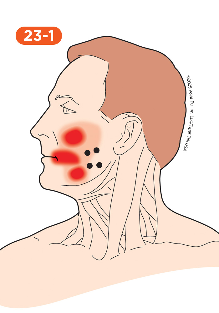Jaw and Teeth Pain 23-1 Masseter Superficial