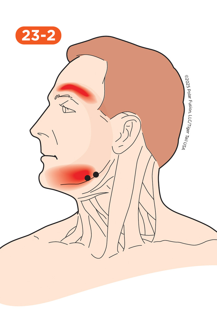 Jaw and Teeth Pain 23-2 Masseter Superficial