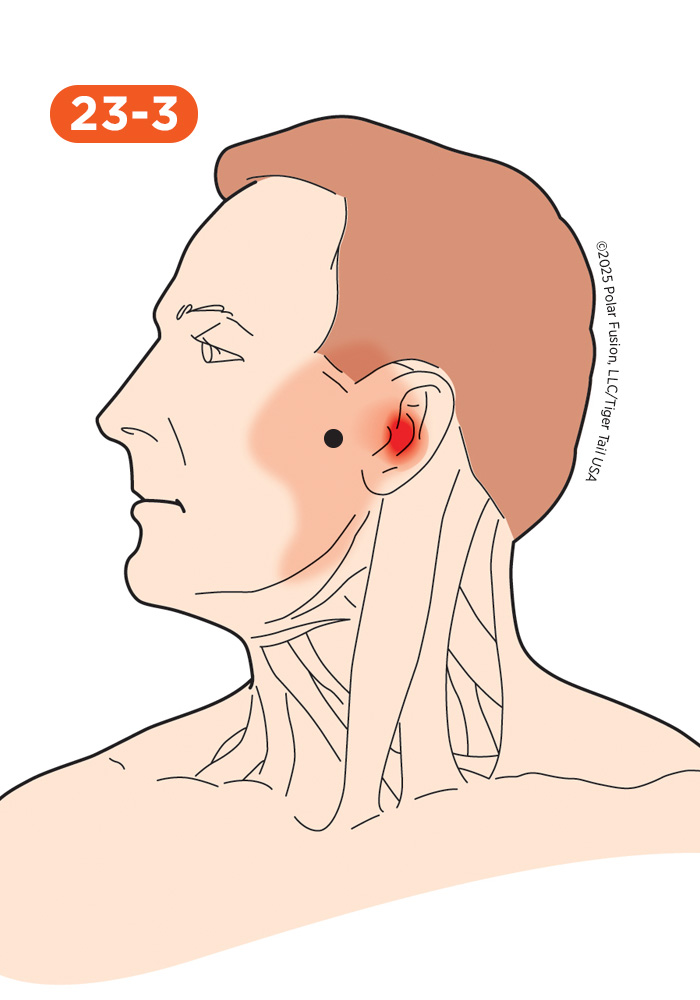 Jaw and Teeth Pain 23-3 Masseter Deep