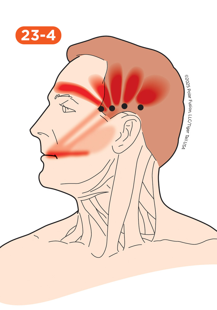 Jaw and Teeth Pain 23-4 Temporalis