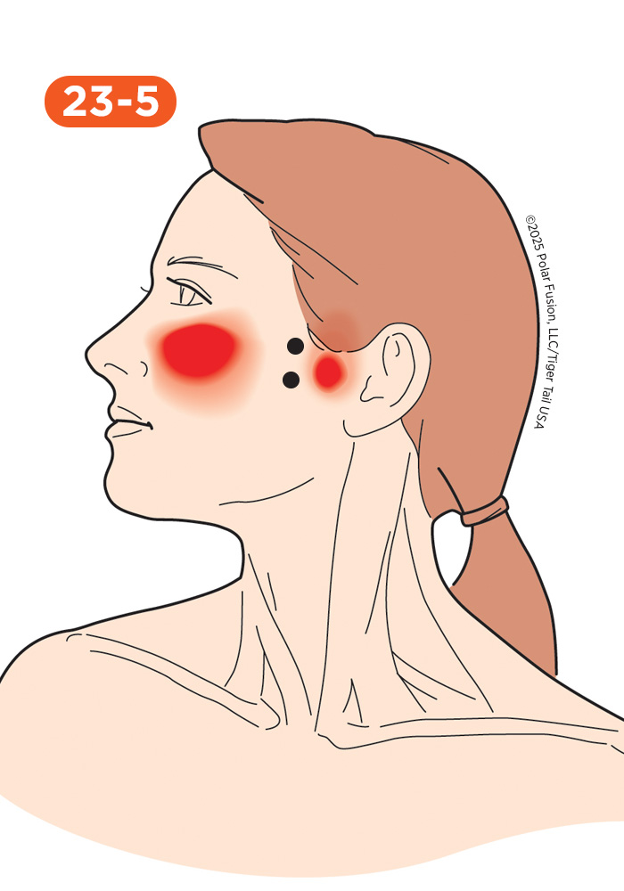 Jaw and Teeth Pain 23-5 Lateral Pterygoid