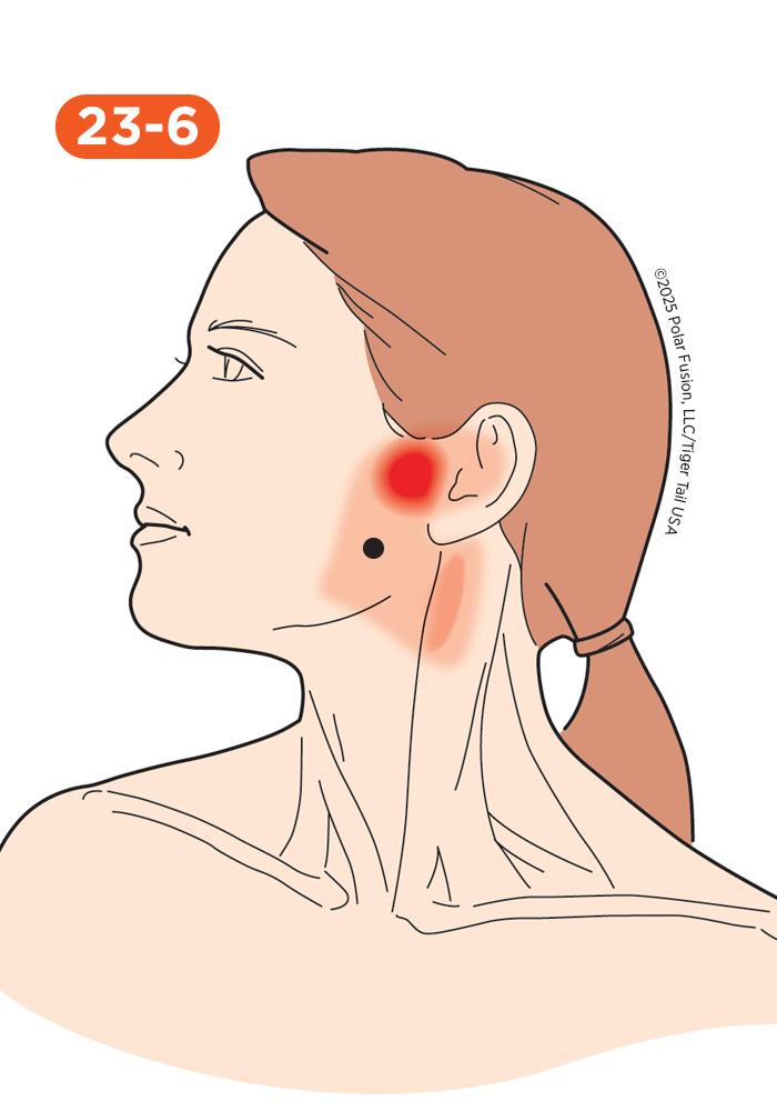 Jaw and Teeth Pain 23-6 Medial Pterygoid