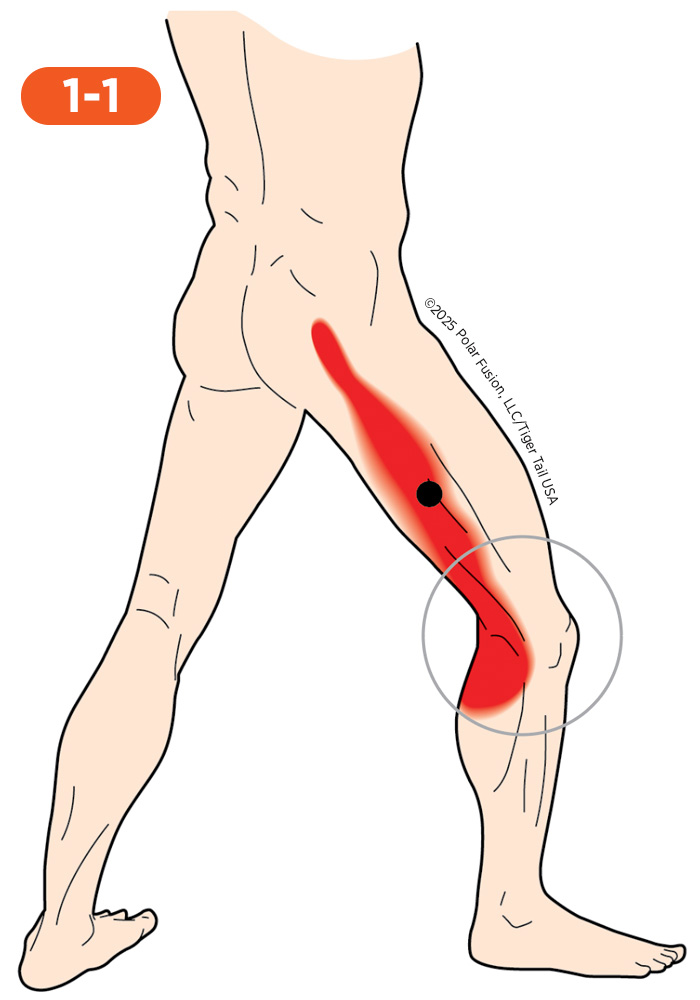 Knee Pain 1-1 Vastus Lateralis