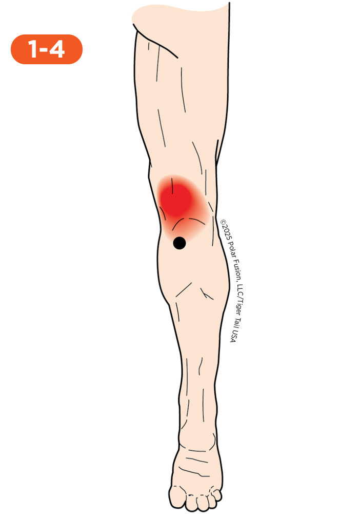 Knee Pain 1-4 Popliteus