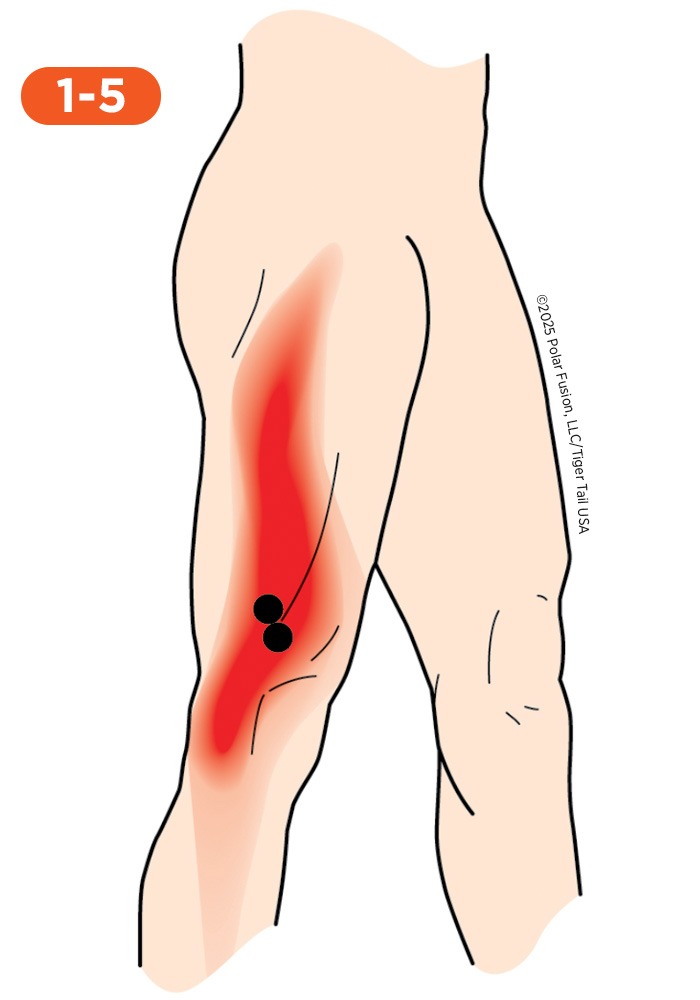 Knee Pain 1-5 Vastus Lateralis