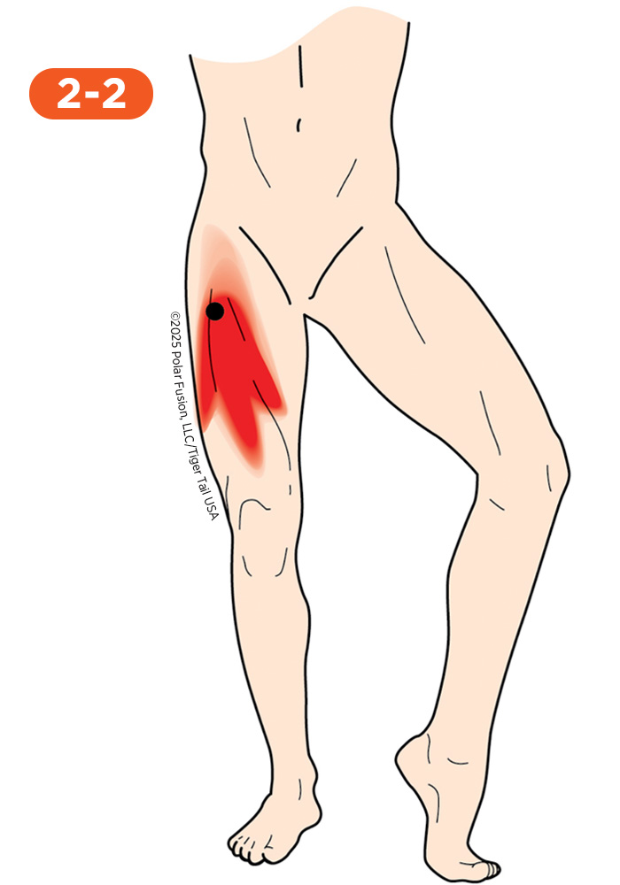 Quadriceps Pain 2-2 Vastus Intermedius