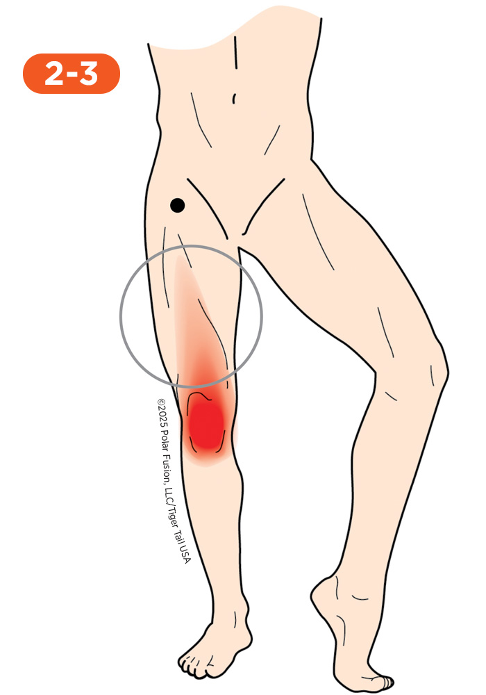 Quadriceps Pain 2-3 Rectus Femoris
