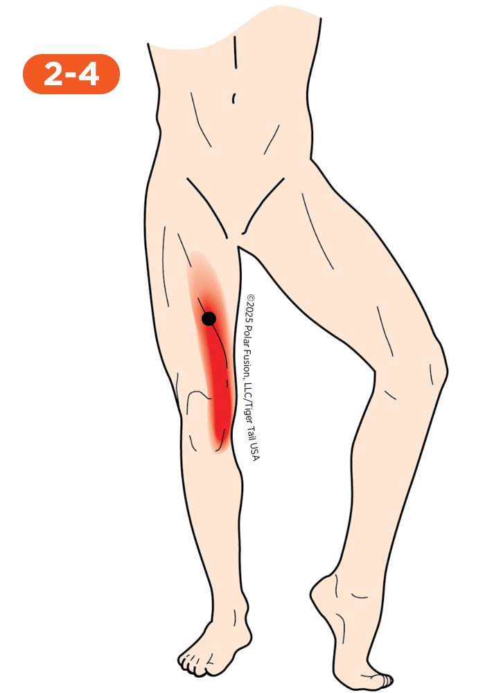 Quadriceps Pain 2-4 Vastus Medialis