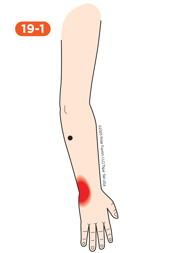 Wrist Pain 19-1 Extensor Carpi Ulnaris