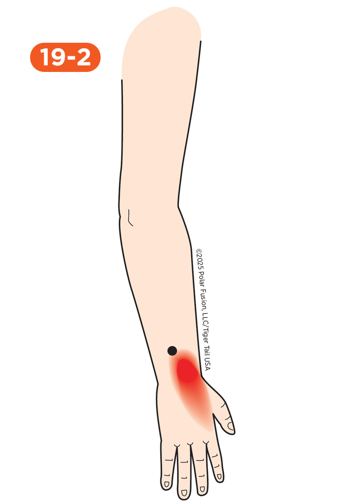 Wrist Pain 19-2 Extensor Indicis