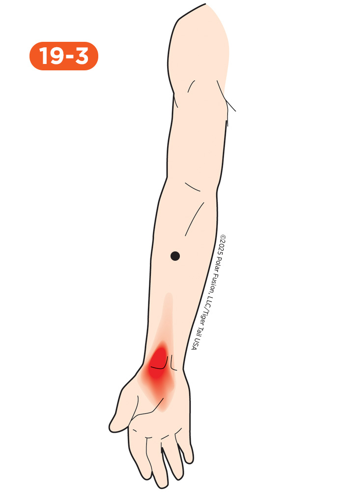 Wrist Pain 19-3 Flexor Carpi Radialis