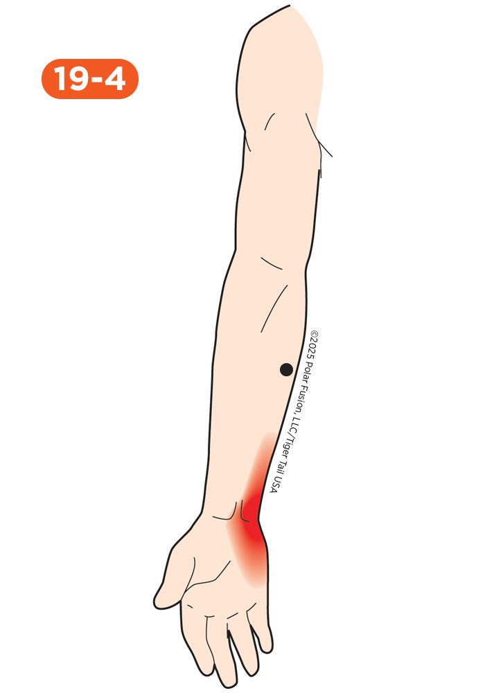 Wrist Pain 19-4 Flexor Carpi Ulnaris