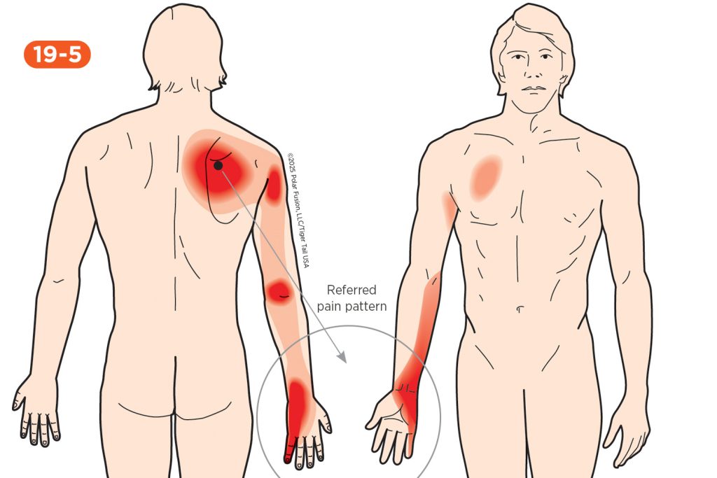 Wrist Pain 19-5 Serratus Posterior Superior